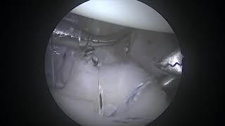 Arthroscopic CapsulorrhaphyCapsular Plication  Patient Version [upl. by Caniff826]