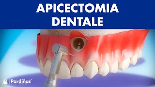 Apicectomia dentale © [upl. by Deland]