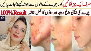 How to Completely Remove Acne Acne Scars and Pimples  100 Effective Results  Nadia [upl. by Camel]