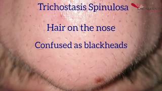 Hair removal on the nose by Laser  Trichostasis Spinulosa [upl. by Isolt]