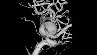 Large Fusiform Aneurysms of ICA flow diverter treatment [upl. by Nyrat396]