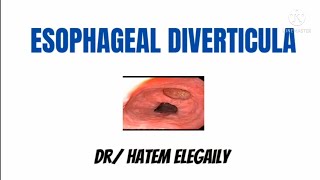 Esophageal Diverticula [upl. by Annaihr]