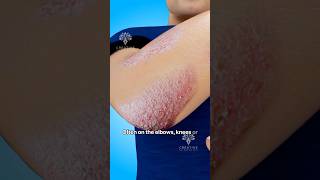 How Does Psoriasis Happen shorts viralvideo skincare  Creativelearning3d [upl. by Alamac256]