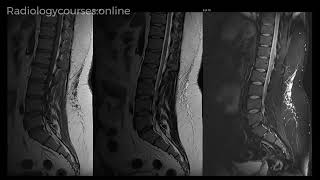 Midline subcutaneous oedema in lumbar spine MRI [upl. by Nevek]