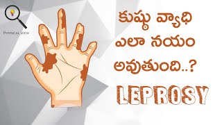 LEPROSY  కుష్ఠు వ్యాధి  LEPROSY IN TELUGU [upl. by Rodrigo]