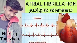 ATRIAL FIBRILLATION IN TAMIL இதய மேலறை நடுக்க நோய் [upl. by Alick]