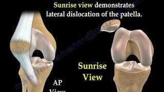 Patellar Dislocations  Everything You Need To Know  Dr Nabil Ebraheim [upl. by Artkele]