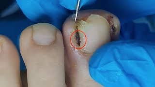 【Daily Pedicure Tutorial】Removing Deeply Embedded Ingrown Toenails on Both Sides of The Big Toe [upl. by Jaycee526]