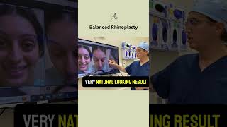 Congenitally Asymmetric And Deviated Nose  Structural Rhinoplasty [upl. by Iorgos]