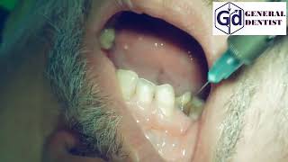 Infiltration anesthesia for treatment 1112 teeth [upl. by Llewen]