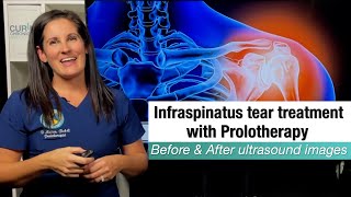 Infraspinatus tear healing with Prolotherapy before amp after ultrasound case presentation [upl. by Varhol437]