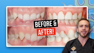 How Do BRACES FIX Overbites  Overbite Before and After Braces  Premier Orthodontics [upl. by Kara]