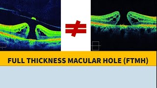 MACULAR HOLE BASICS amp PATHOPHYSIOLOGY [upl. by Elinor]