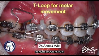 T loop for molar mesialization protraction by dr ahmed adel orthodontics [upl. by Eittam]