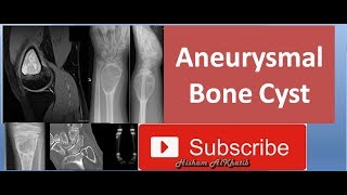 Aneurysmal Bone Cyst [upl. by Ocirled679]