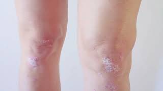 Septic Arthritis Causes Symptoms and management [upl. by Kellen616]