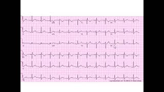 Stepwise Interpretation 4 Ectopic Atrial Rhythm [upl. by Aehsa]