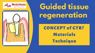 Guided Tissue Regeneration  Concept of GTR I Periodontal Regeneration l Mediklaas [upl. by Stochmal]