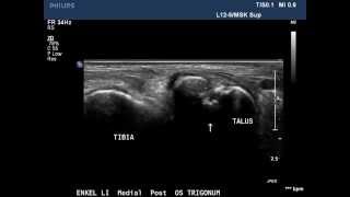 Ultrasound Posterior Ankle Impingement Syndrome Os Trigonum  Drs S Konijnenberg wwwiconenl [upl. by Atnohs755]