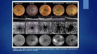 ANGIO–OCT EN EDEMA MACULAR DIABÉTICO 2018 [upl. by Renae]