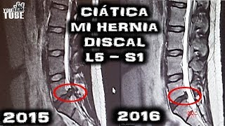 CIATICA HERNIA DISCAL L5S1 TRATAMIENTO MI RESONANCIA MAGNÉTICA Sané SIN cirugía [upl. by Annalee]