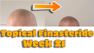 Topical FinasterideMinoxidl Week 21 Progress [upl. by Aekahs854]