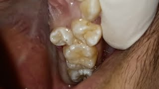 Exodontia malposed Upper Premolar [upl. by Eineg]