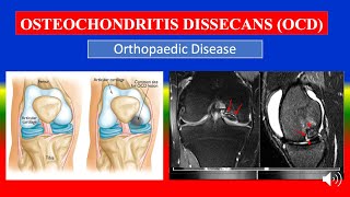 OSTEOCHONDRITIS DISSECANS OCD  Definition types causes pathophysiology symptoms medicine [upl. by Spoor]