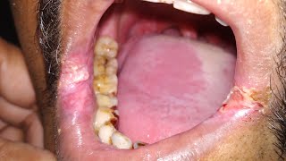 Leukoplakia signs and symptoms [upl. by Aube]