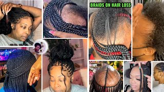 HAIR LOSS AMAZING HAIRSTYLES IDEAS FOR BLACK WOMENALOPECIA BRAIDS HAIRSTYLES [upl. by Rider]