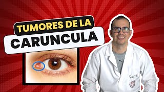 Tumores en la Carúncula 👁️👁️  Síntomas Diagnóstico y Tratamiento 🏥  2024 [upl. by Sidney142]