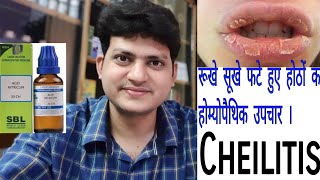 रूखे सूखे और फटे हुए होंठ  Dry cracked and peeling lips  Homeopathic Medicine for Cheilitis [upl. by Arvid]