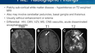 Progressive Multifocal Leukoencephalopathy PML [upl. by Ennyrb]