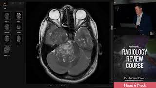 Trigeminal Schwannoma  Radiology Review Course [upl. by Ahsac81]