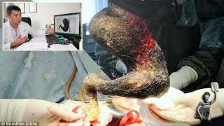 Doctors remove 9pound hairball from teens stomach [upl. by Woodrow567]