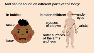 Does My Child have Eczema  American Academy of Pediatrics AAP [upl. by Saltsman]