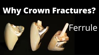 Why dental Crown Fails Ferrule Effect post amp Core Prosthodontics basic Lectures [upl. by Dielu624]