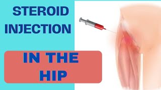 Hip Steroid Injections Explained Benefits amp Risks [upl. by Kcirredal]