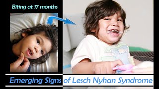 Early Emerging Signs of Lesch Nyhan Syndrome in DaveyBiting Started at 17 months [upl. by Thora]