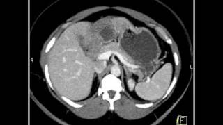 Abdomen Liver Hemangioma of the Liver8 of 8 [upl. by Ansilme891]