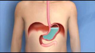 Heartburn Acid Reflux GERDMayo Clinic [upl. by Adelbert]