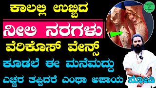 ರಕ್ತನಾಳಗಳ ಉಬ್ಬುವಿಕೆ ವೆರಿಕೋಸ್ ವೇನ್ಸ್ ಗೆ ಮನೆಮದ್ದು Varicose Veins Treatment Kannada  ನೀಲಿ ನರಗಳು [upl. by Ylac]