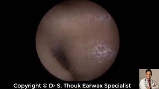 Daily Earwax Removal Extraction by Dr Thouk Earwax Specialist 46 [upl. by Simara]