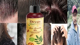 Deyga Hair Growth Oil  Honest Review [upl. by Lebatsirhc950]