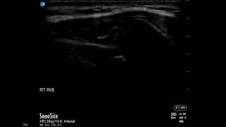 Rib Ultrasound Subluxation at the Costochondral Junction Long Axis [upl. by Lerrad]