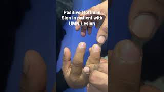 Positive Hoffman Sign in patient with UMN lesion [upl. by Bak]