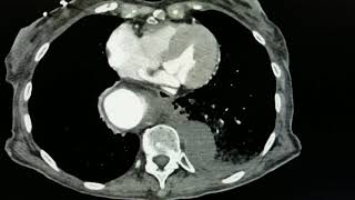 Aortic Aneurysm CT JETem 2018 [upl. by Marian]