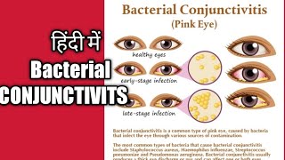 Nursedidi Bacterial conjunctivitis explain in Hindi CONJUNCTIVITS lecture in hindi [upl. by Genie373]