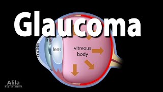 Development of Glaucoma Animation Open Angle vs Angle Closure Glaucoma [upl. by Annaynek]