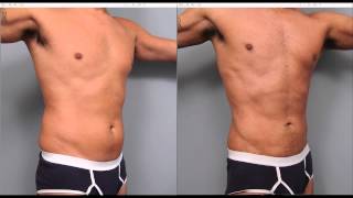 The Benefits of Liposuction for Men  Dr Sterry Explains [upl. by Yv]